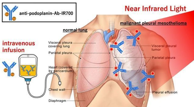 Can Infrared Light Cause Cancer Exploring the Risks and Facts